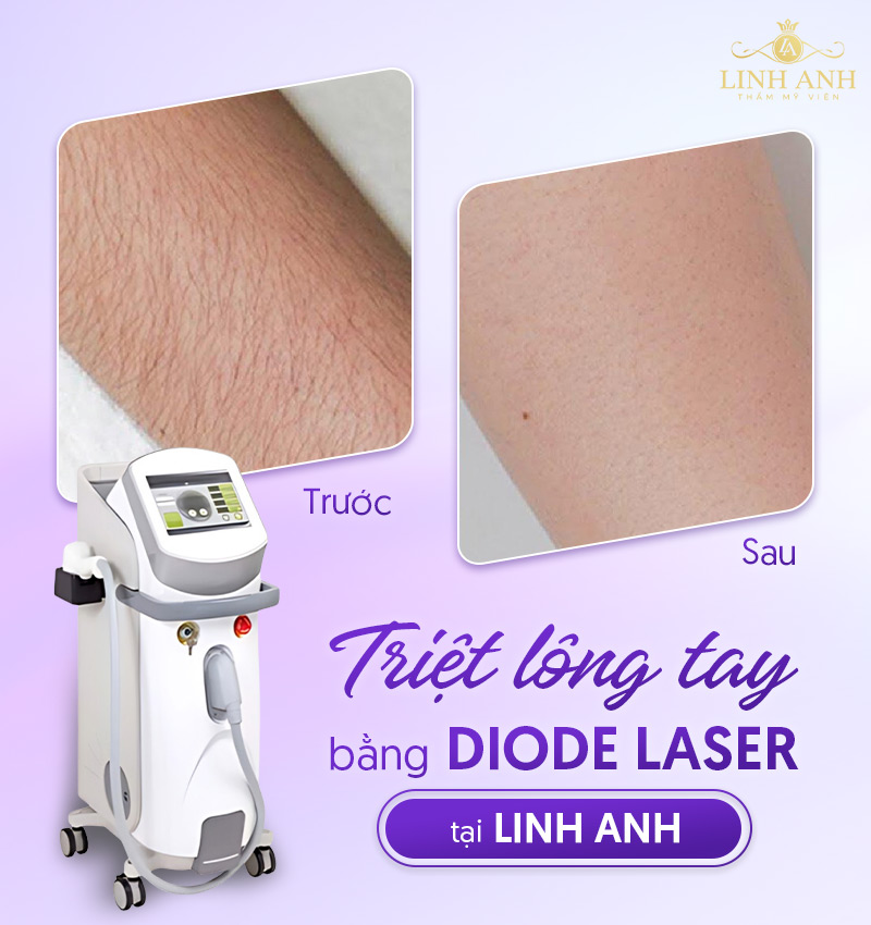 Khách hàng triệt lông tay bằng Diode Laser tại Linh Anh Hình ảnh triệt lông tay Diode Laser