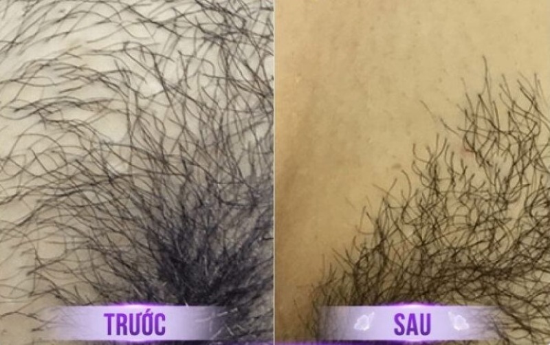 hình ảnh trước sau triệt lông vùng kín