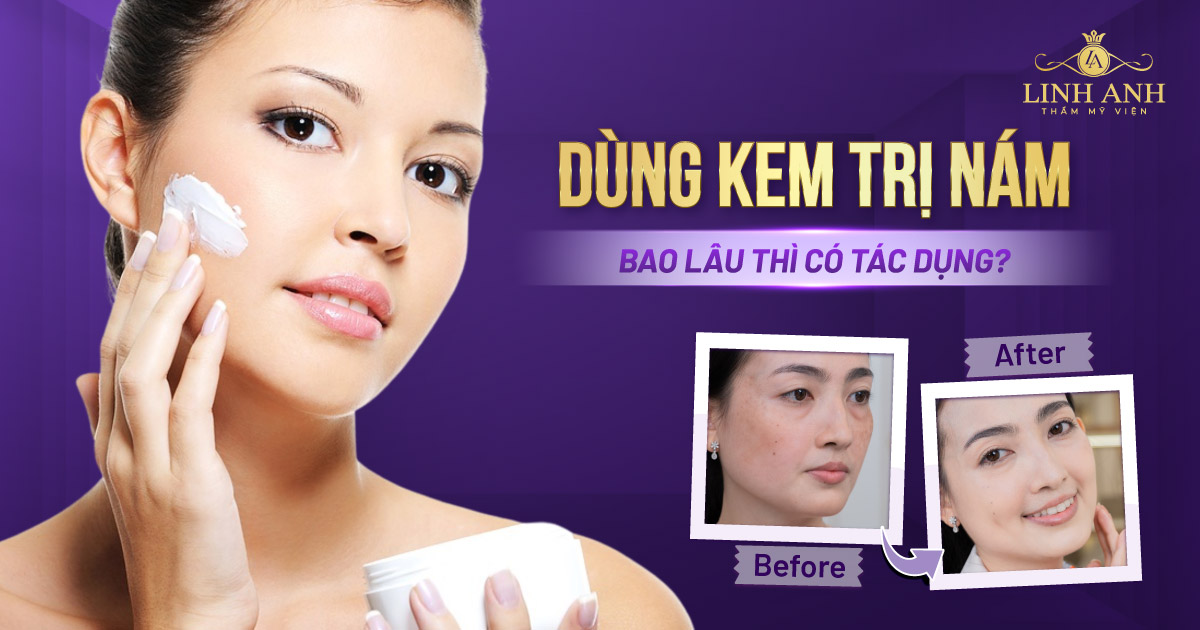 Dùng kem trị nám bao lâu thì có tác dụng, da sáng mịn màng?