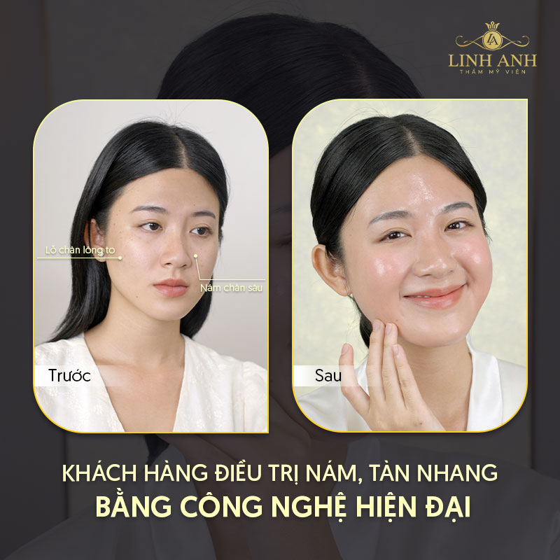 sử dụng công nghệ laser trị nám