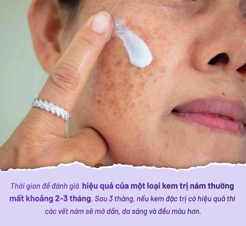 dùng kem trị nám