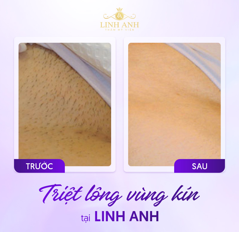 Kéo tỉa lông bikini Kéo tỉa lông bikini