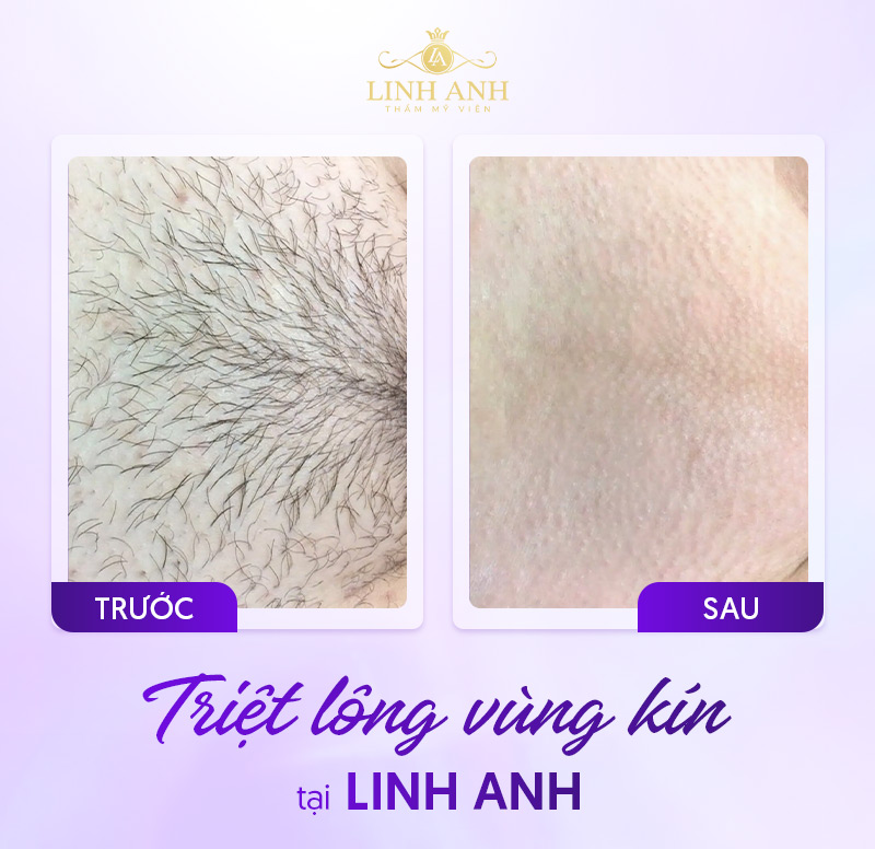 Kéo tỉa lông vùng kín