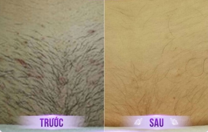 kết quả trước sau triệt lông vùng kín