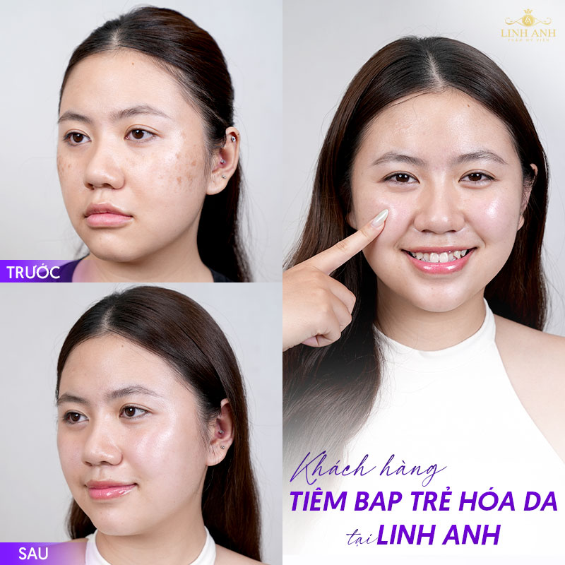 Khách hàng tiêm BAP trẻ hóa da tại Linh Anh
