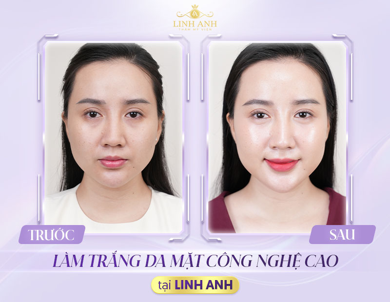Làm trắng da mặt công nghệ cao tại Linh Anh