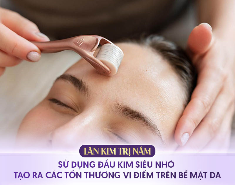 lăn kim trị nám có tốt không
