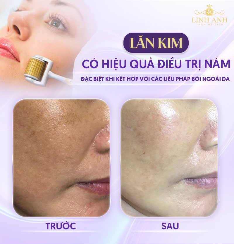 lăn kim trị nám có hiệu quả không