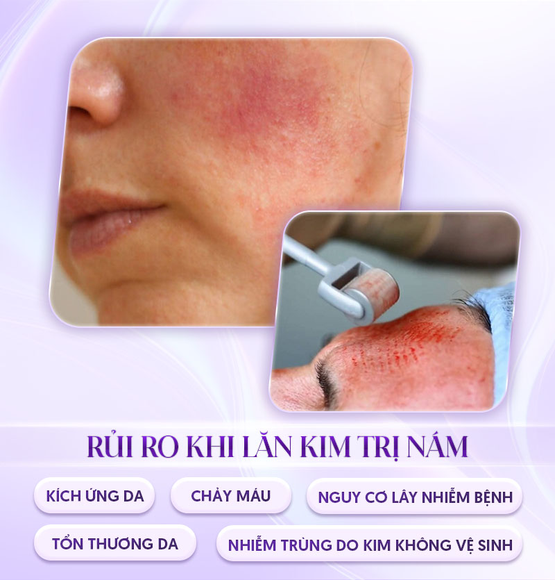 rủi ro khi lăn kim trị nám