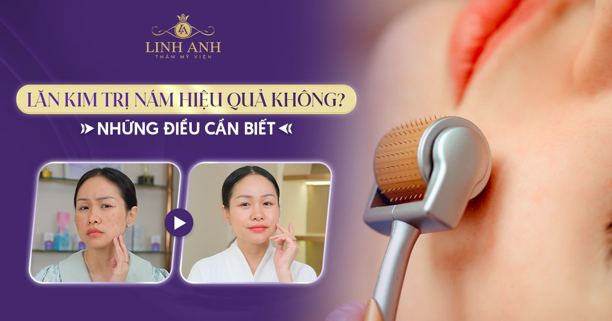 Lăn kim trị nám hiệu quả không? Quy trình và lưu ý nên biết