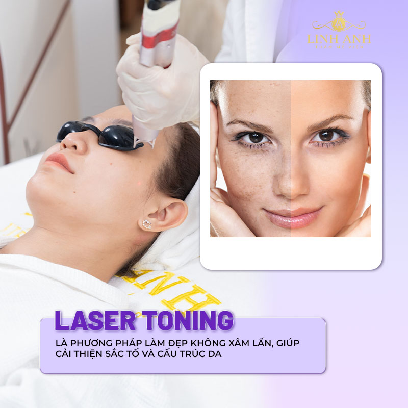 laser toning là gì