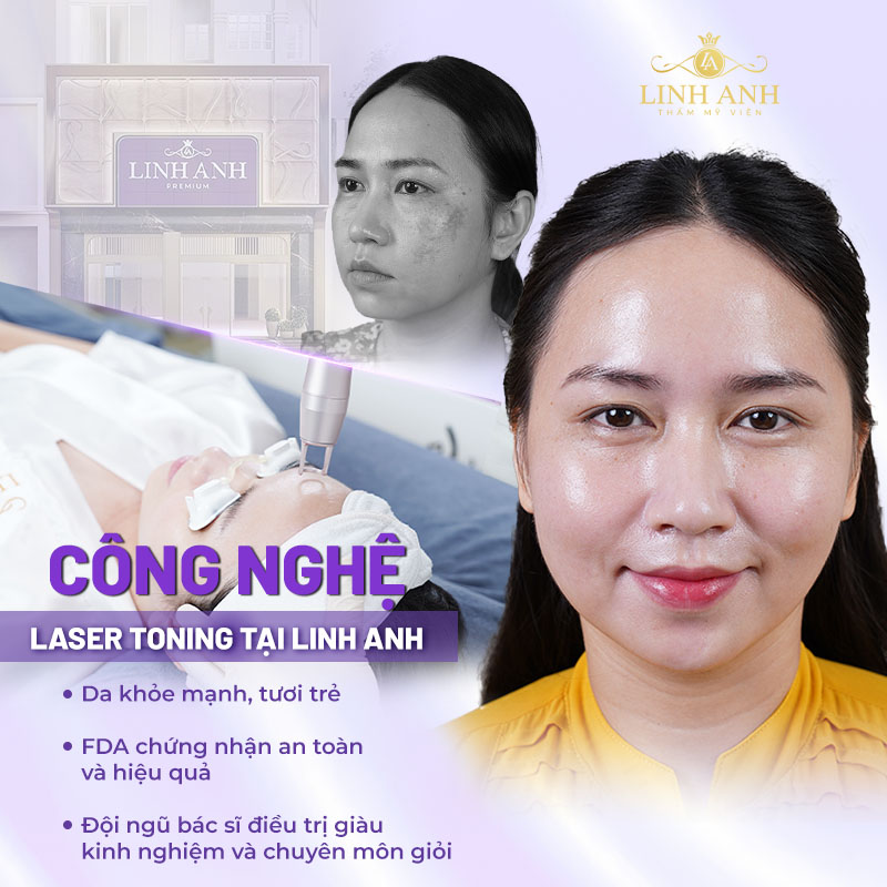 công nghệ laser toning