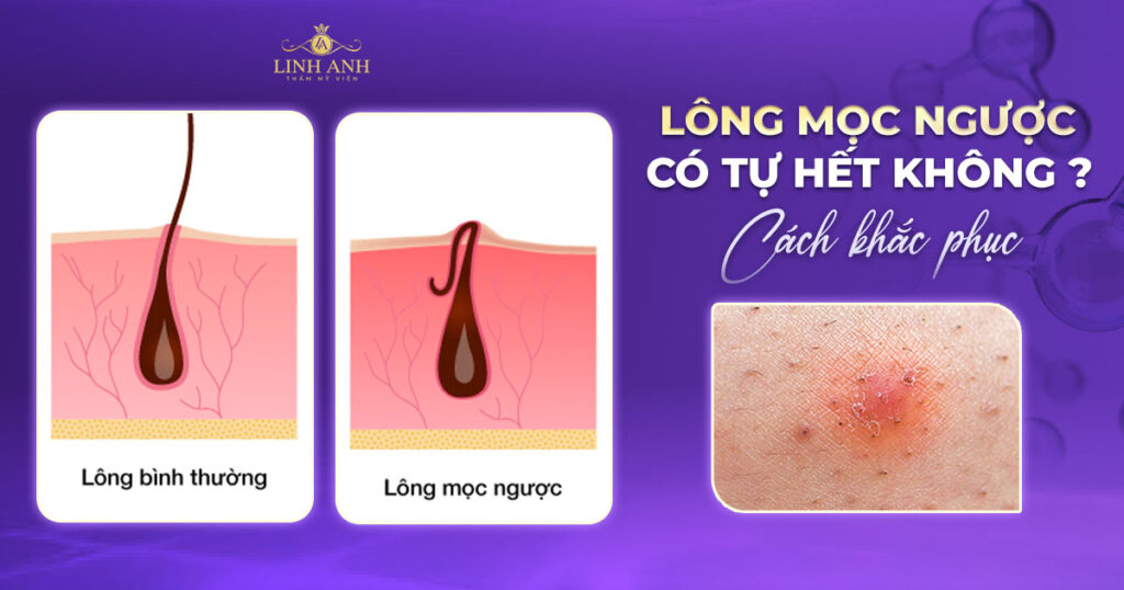 Lông mọc ngược có tự hết không