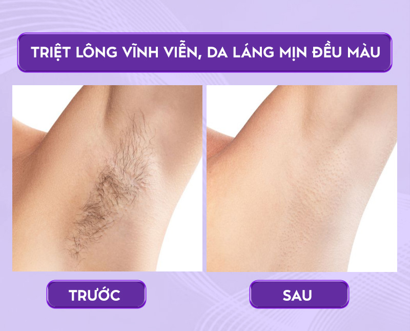 lưu ý để triệt lông không đau lưu ý để triệt lông không đau