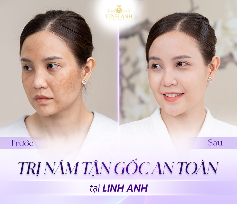 khách hàng điều trị nám thành công