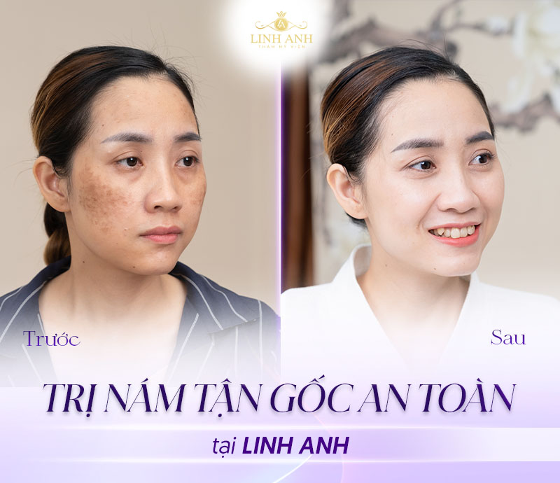 khách hàng điều trị nám thành công