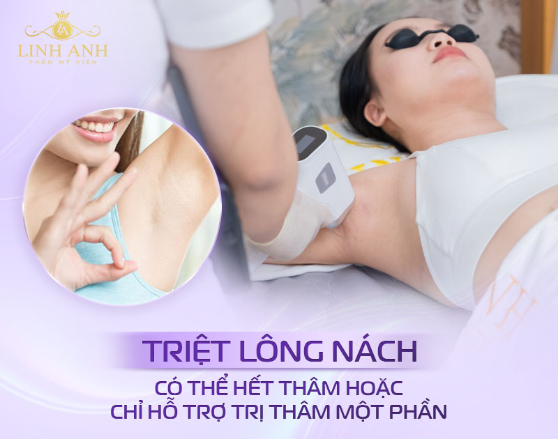 nách có hết thâm sau triệt lông không nách có hết thâm sau triệt lông không