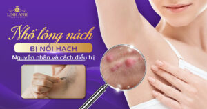 nhổ lông nách bị nổi hạch