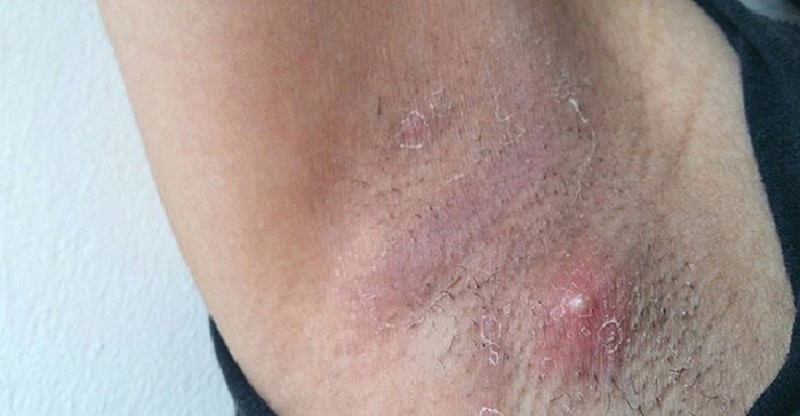 nhổ lông nách bị nổi hạch xử lý sao nhổ lông nách bị nổi hạch xử lý sao