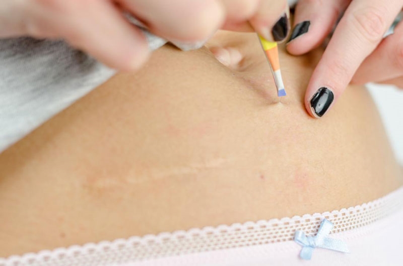 Nhổ lông vùng kín có mọc lại không