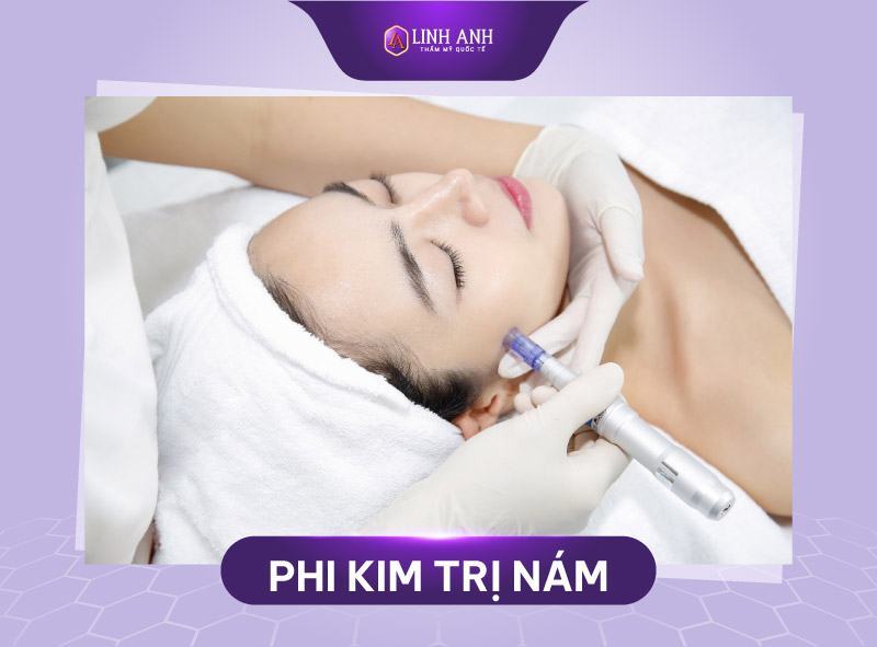 phi kim trị nám - Viện thẩm mỹ Quốc tế Linh Anh phi kim điều trị nám