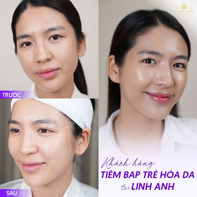 Review tiêm BAP trẻ hóa da tại Linh Anh