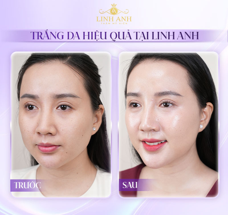 Review tiêm meso trắng da