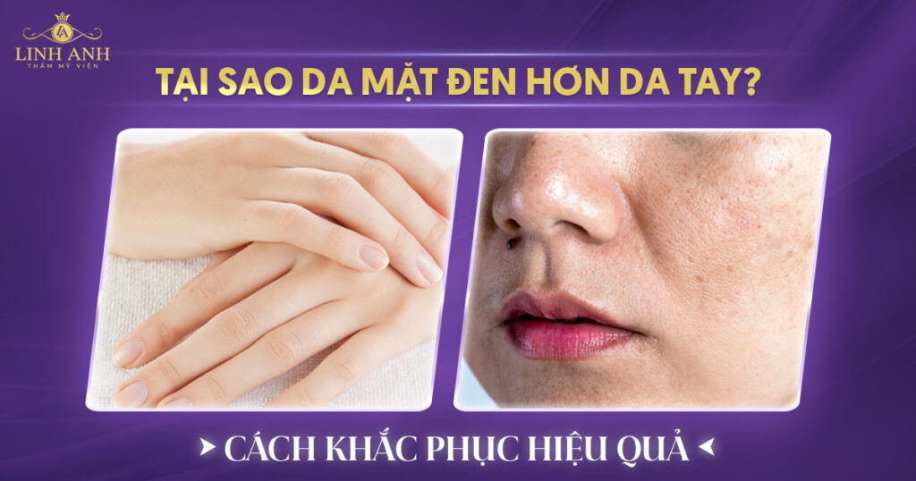 Tại sao da mặt đen hơn da tay