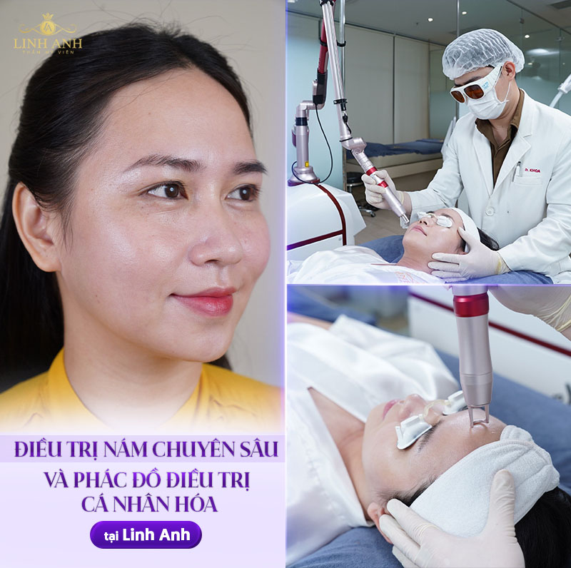 điều trị nám chuyên sâu tại TMQT Linh Anh
