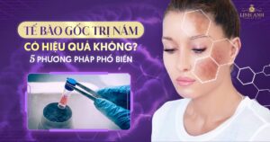 tế bào gốc trị nám