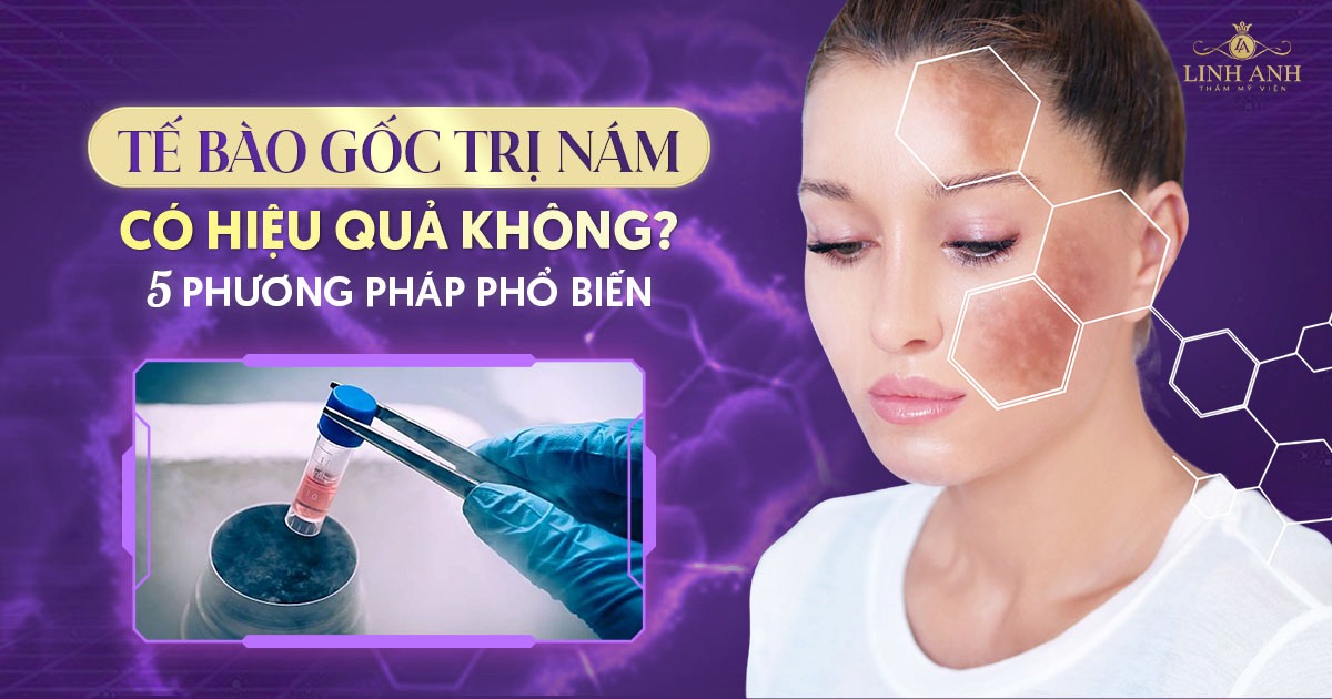 Tế bào gốc trị nám có hiệu quả không? 5 phương pháp phổ biến