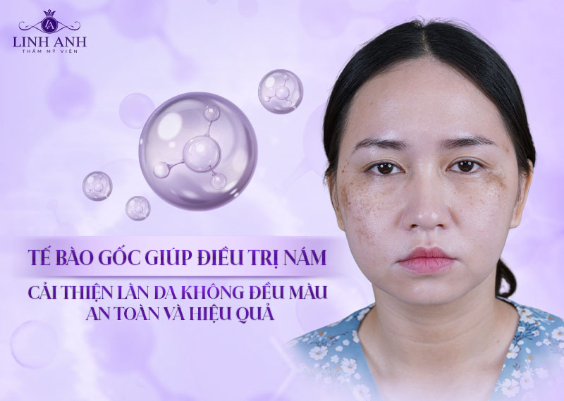 tế bào gốc giúp điều trị nám