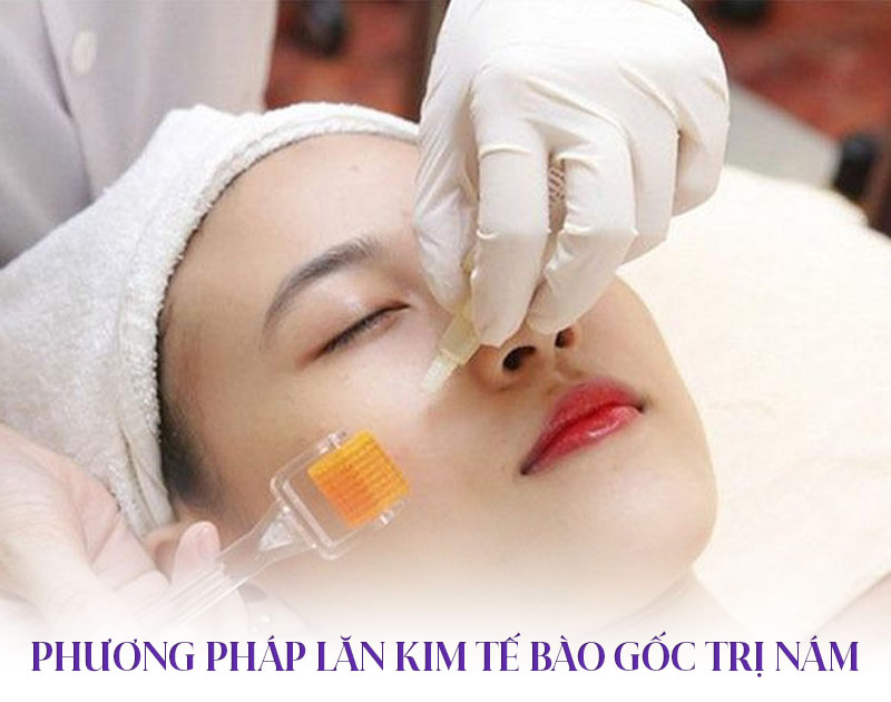 trị nám, sạm, tàn nhang bằng tế bào gốc