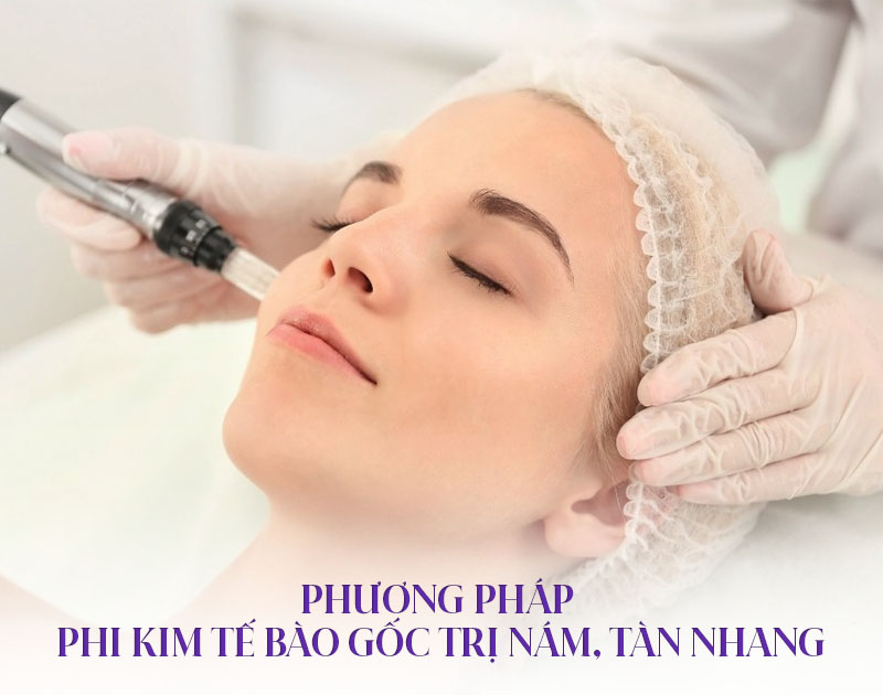 lăn kim tế bào gốc trị nám
