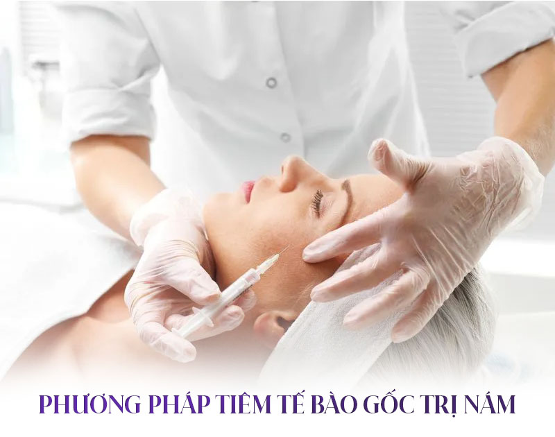 phương pháp tiêm tế bào gốc trị nám