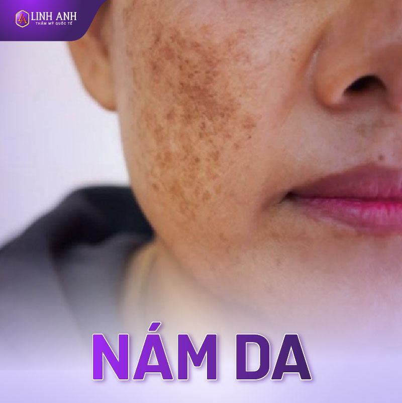 thuốc điều trị nám da mặt