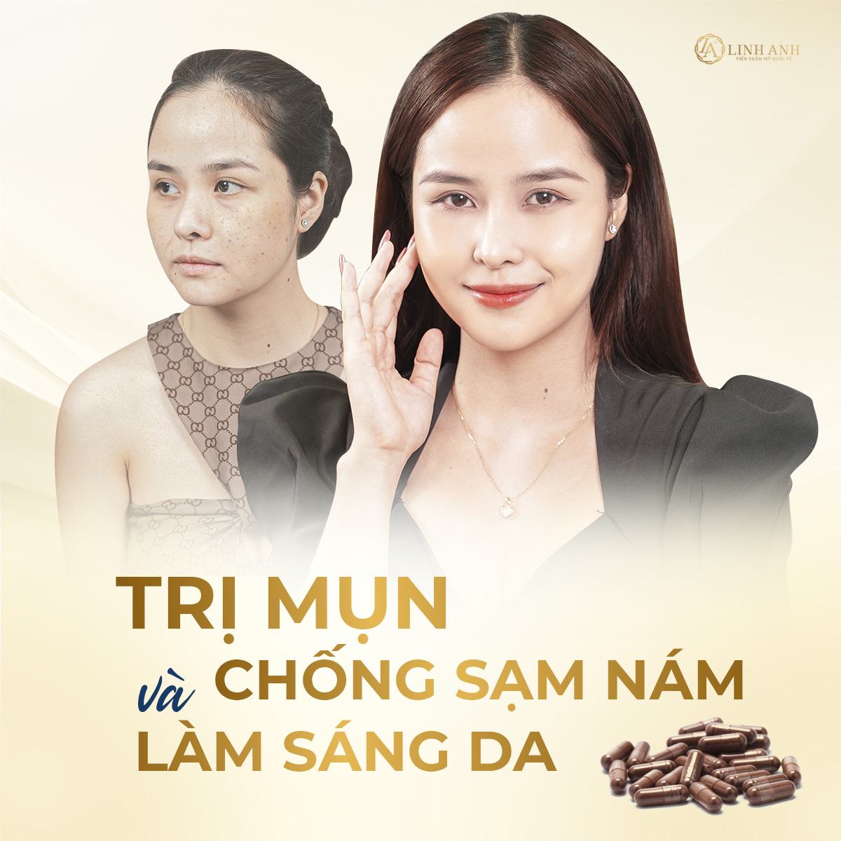 l-cystine trị nám thuốc l cystine trị mụn - Viện thẩm mỹ quốc tế Linh Anh