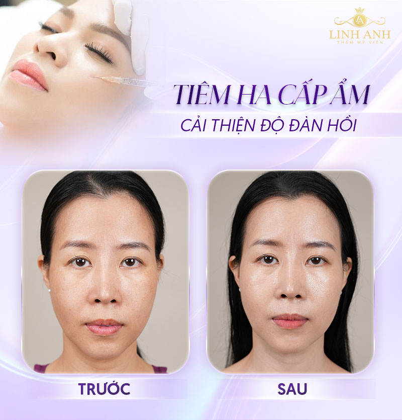 Tiêm HA cấp ẩm, cải thiện độ đàn hồi