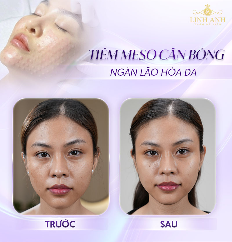 Tiêm Meso căng bóng, ngăn lão hóa da