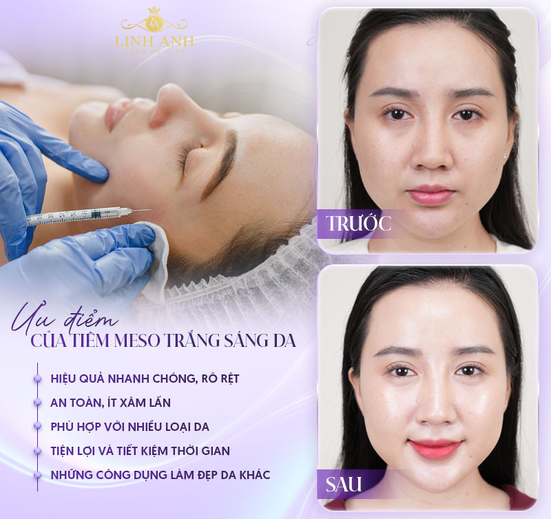 Tiêm meso trắng da có hiệu quả không Tiêm meso trắng da có hiệu quả không
