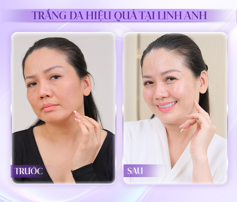 Tiêm meso trắng da được bao lâu