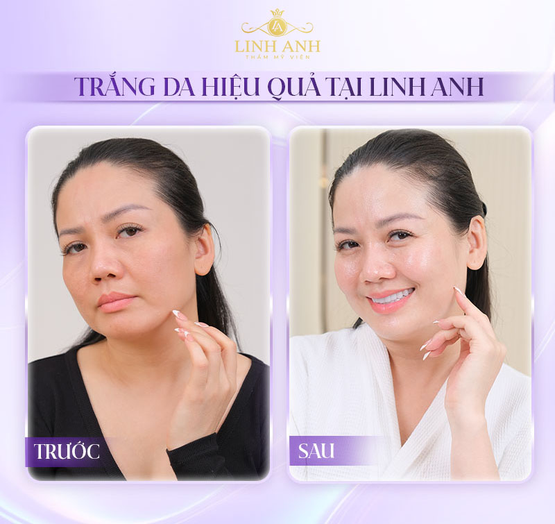 Tiêm meso trắng da ở đâu