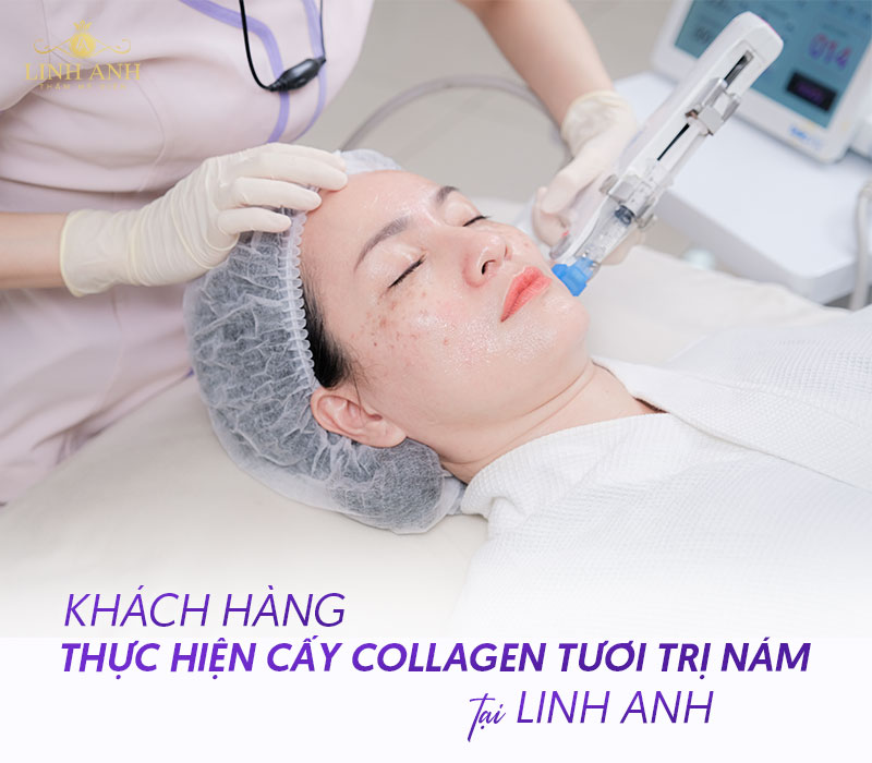 Trị nám bằng công nghệ hiện đại