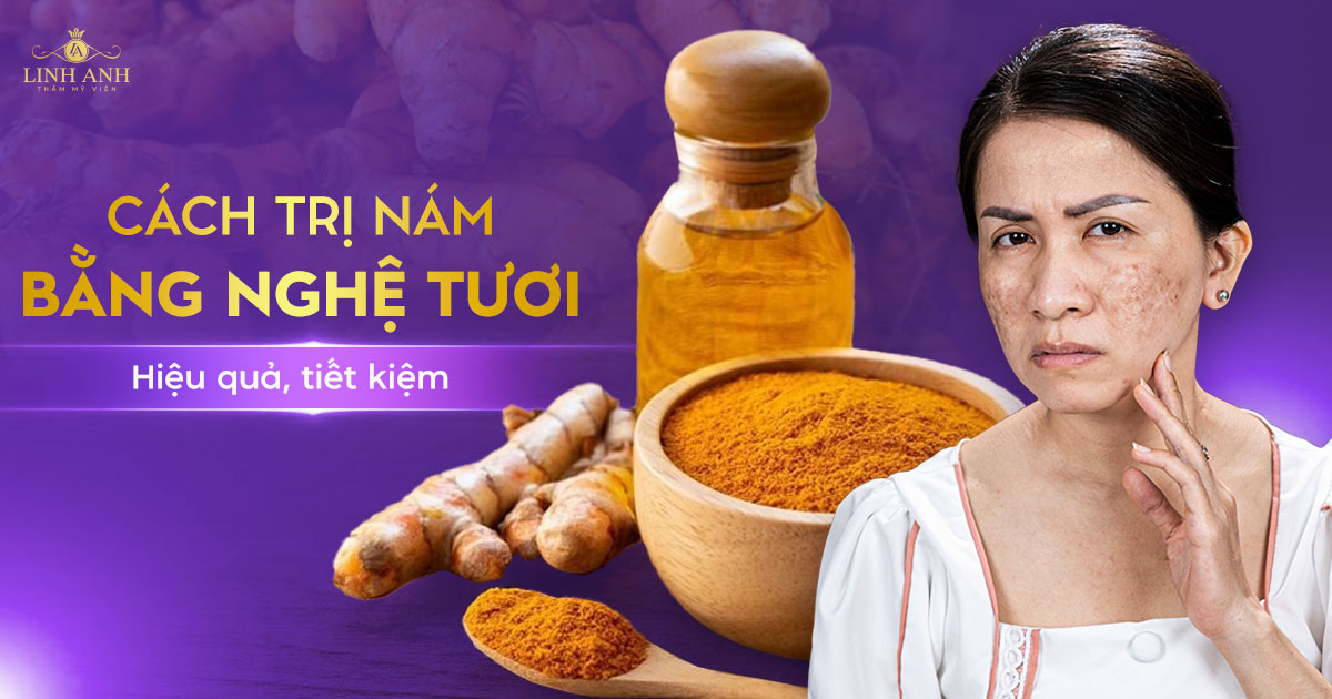 TOP 12 cách trị nám bằng nghệ tươi hiệu quả, tiết kiệm tại nhà