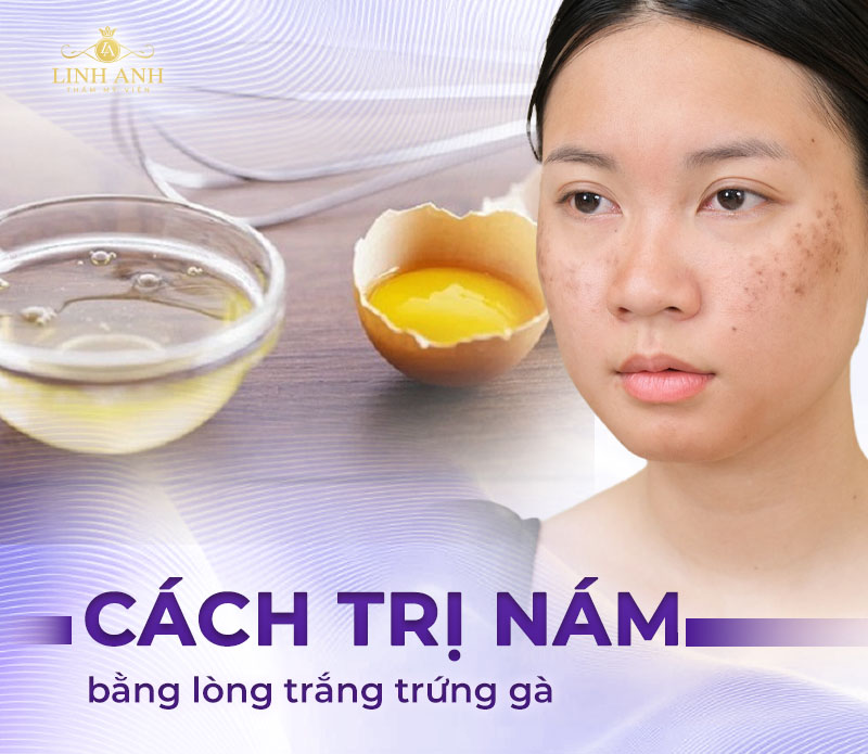 Trị nám bằng trứng lòng trắng trứng gà