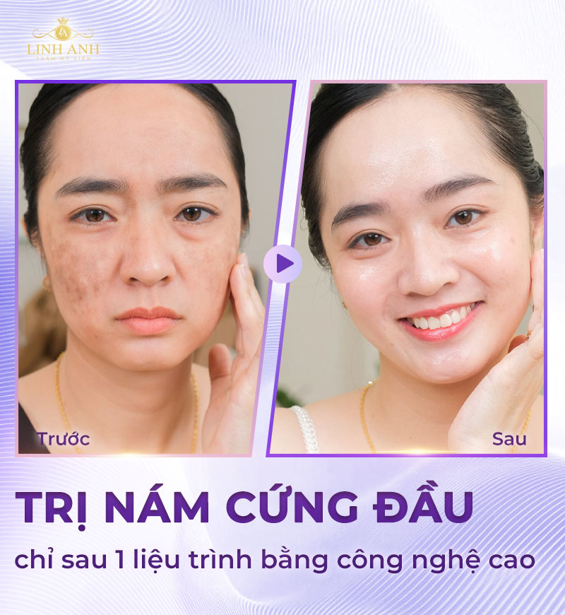 Trị nám cứng đầu tại Linh Anh