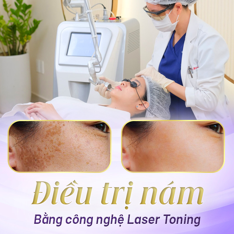 trị nám bằng laser tonning