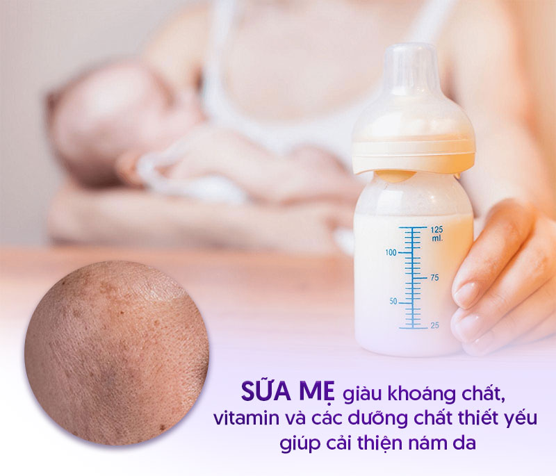 Trị nám sau sinh bằng sữa mẹ được không