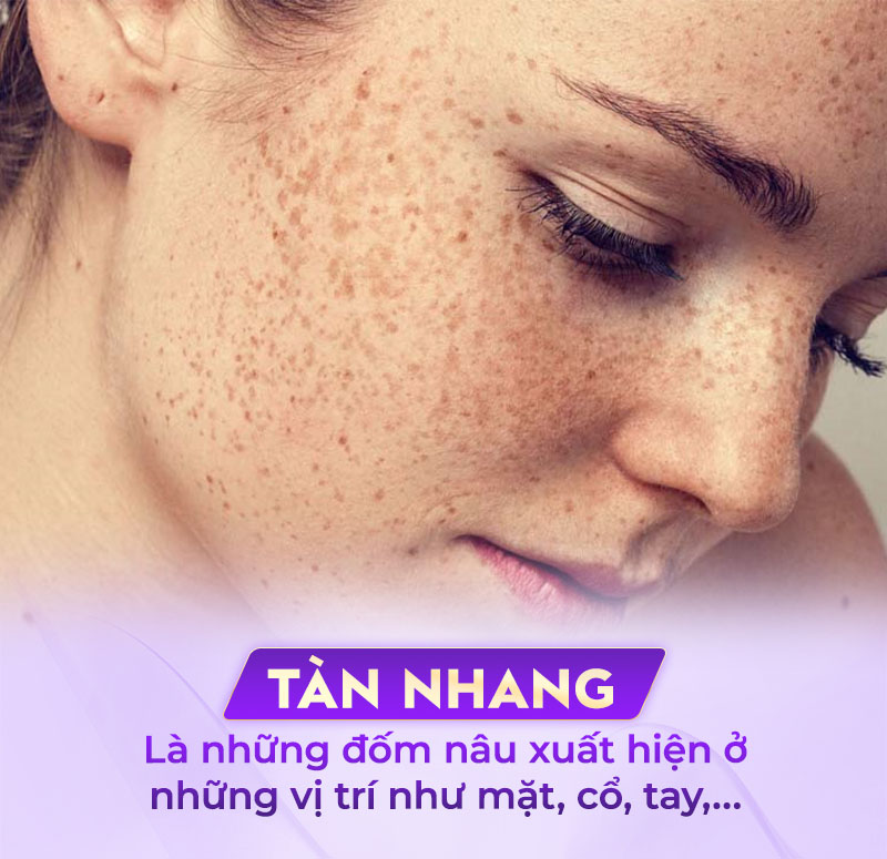 tàn nhang là gì