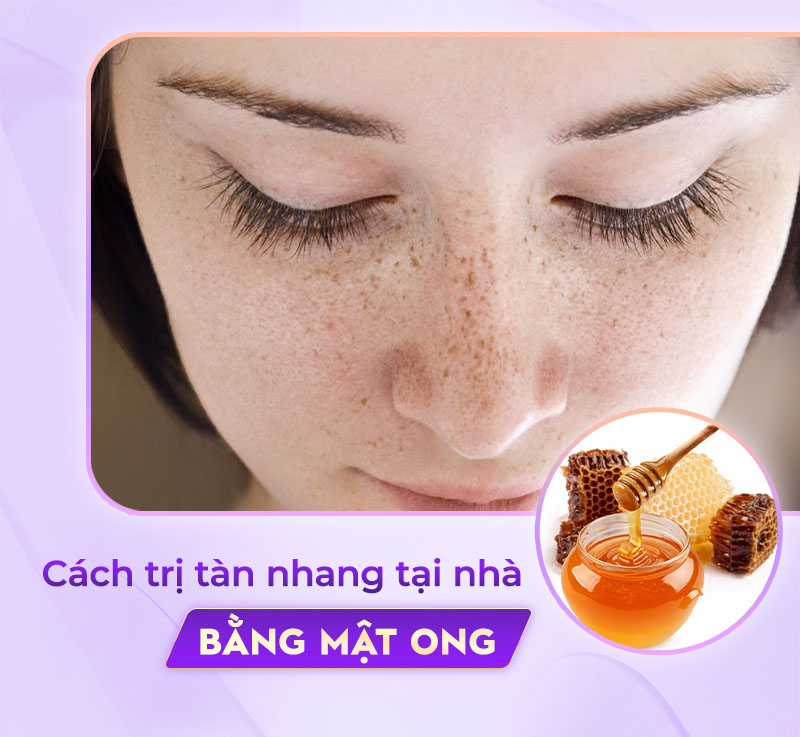 cách trị tàn nhang tại nhà bằng mật ong